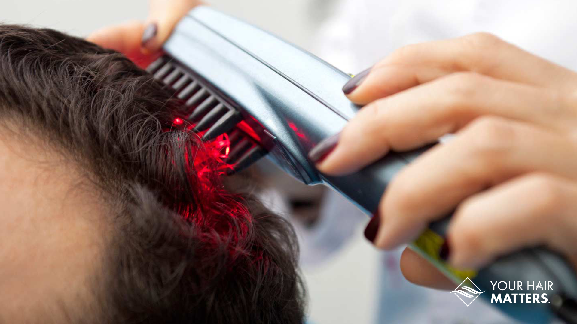 Laser Hair Therapy | Your Hair Matters | Stimulate Hair Regrowth | Hair Thinning | Male Patter Baldness | YOURS | Consultation | Whole Sale Hair Systems