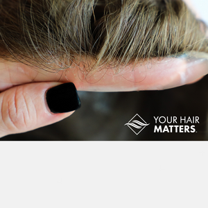 CLOSE-UP OF V-LOOP SKIN SYSTEM | THIN SKIN HAIR SYSTEM | MENS HAIR SYSTEM | MALE PATTERN BALDNESS | YOUR HAIR MATTERS