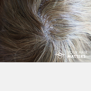 V-LOOP SKIN SYSTEM | THIN SKIN HAIR SYSTEM | MENS HAIR SYSTEM | MALE PATTERN BALDNESS | YOUR HAIR MATTERS | MENS HAIR LOSS